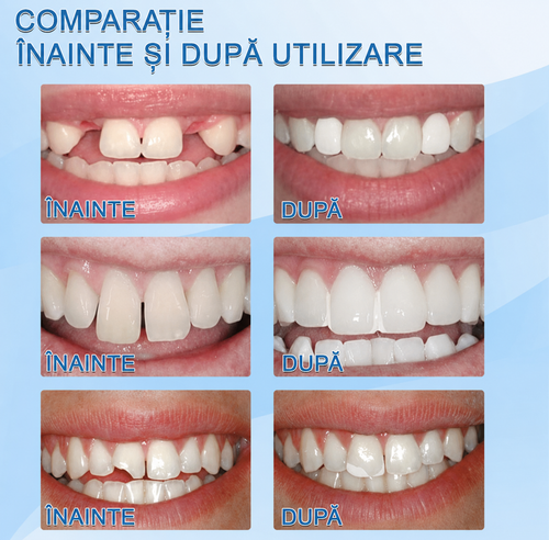 Kit de reparare a dinților cu aspect natural